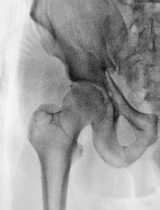 Bone density scans can predict dementia.